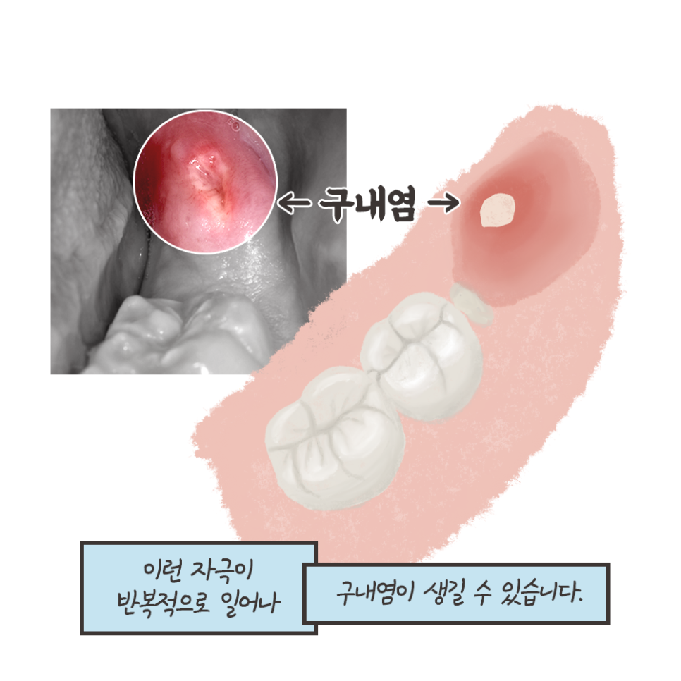 사랑니 발치 이유!! 최악의 경우 이렇게까지 된다..? (냐폴레옹툰 7화) 관련 이미지 7
