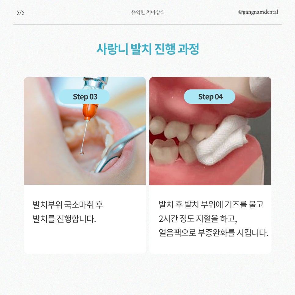 사랑니 발치에 대한 모든것, 사랑니 총정리! / 종류, 비용, 발치과정, 관리, Q&A까지! / 강남레옹치과 관련 이미지 6