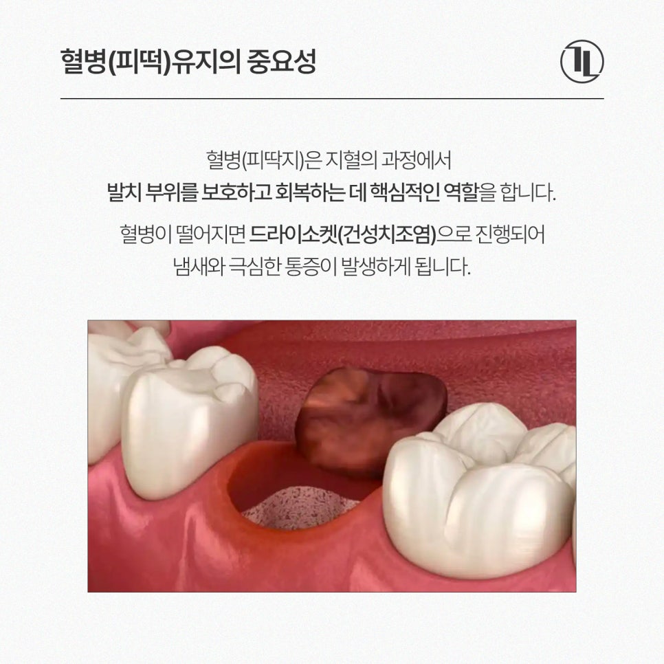 사랑니 발치 지혈이 안된다? / 지혈을 위한 6가지 / 지혈제란? / 강남레옹치과 관련 이미지 3