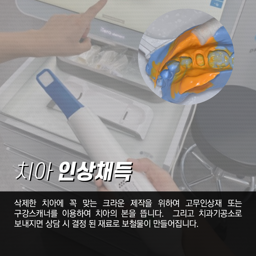 치아 크라운 과정, 어떤 순서로 진행이 될까? 관련 이미지 4