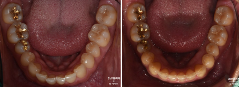 인비절라인 특징&middot;후기&middot;가격 총정리! 투명교정 완벽 가이드 / 강남역 교정치과 강남레옹치과 관련 이미지 5