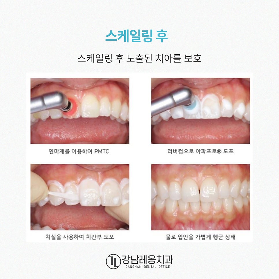 충치예방부터 시린이 완화까지! 아파프로 치아영양제의 5가지 효과✨ / 강남레옹치과 관련 이미지 9