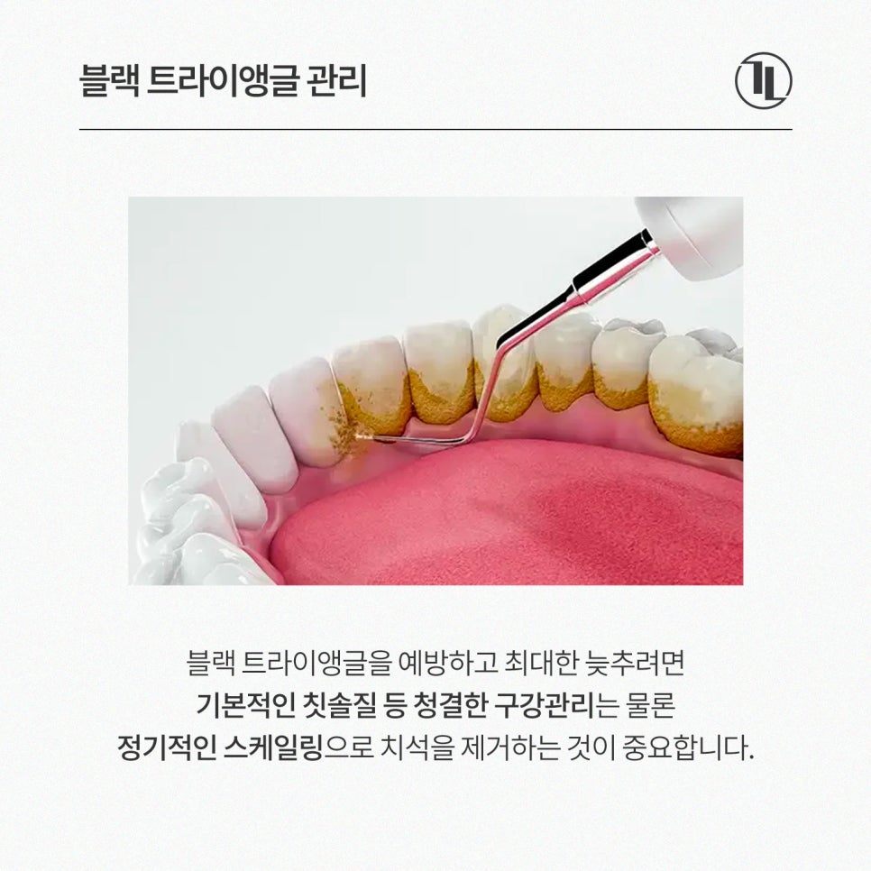 앞니 공간 블랙 트라이앵글 개선, 강남레옹치과 앞니치료 뉴티스 관련 이미지 5