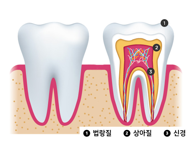 통증없는 충치, 치료하지 않아도 될까? / 충치치료 종류와 비용 / 강남레옹치과 관련 이미지 3