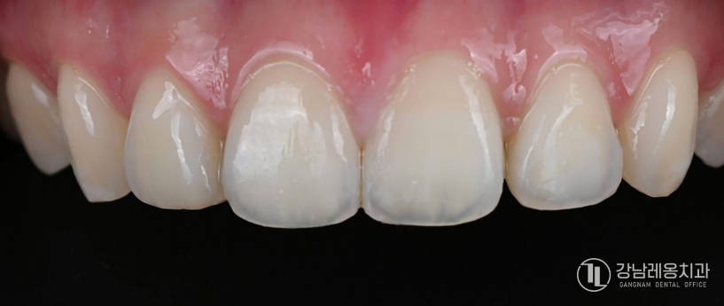 앞니 끝이 살짝 깨졌다면? 뉴티스 치아성형으로 자연스럽게 치아라인 정리하기 관련 이미지 7
