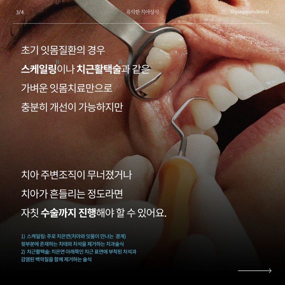 잇몸질환 자가진단 체크리스트~! / 강남레옹치과 잇몸치료 관련 이미지 4