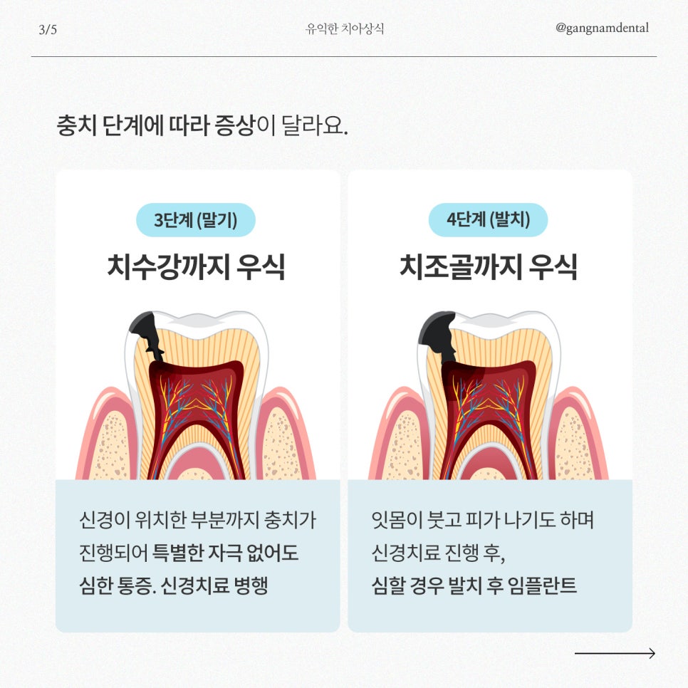 강남레옹치과에서 알려드리는 충치가 생기는 의외의 이유! 관련 이미지 4