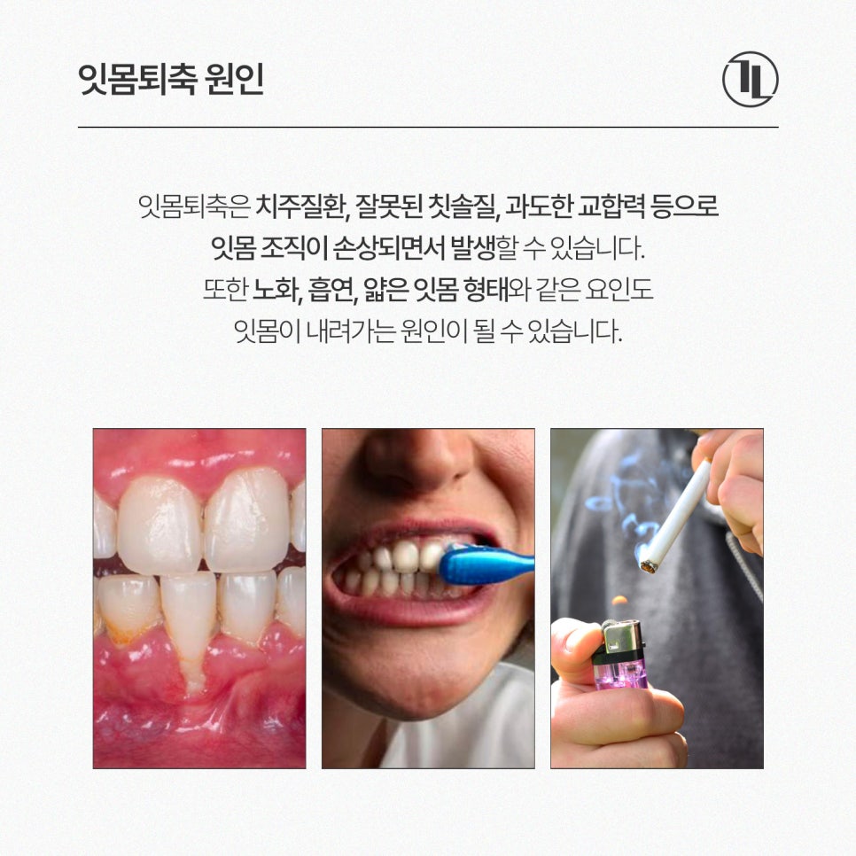 Receding Gums and Tooth Sensitivity, Gum Recession / A Complete Guide from Causes to Treatment / Gangnam Leon Dental Clinic image 3