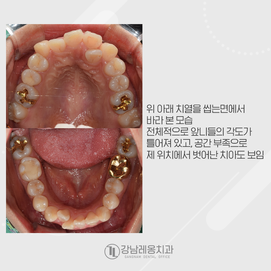 치아총생 덧니를 가지런하게 교정~! 관련 이미지 3