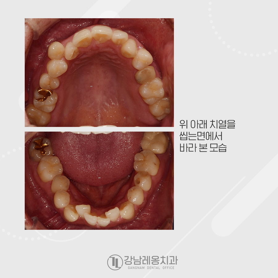 발치 치아교정, 덧니 총생 반대교합까지 한번에 해결 관련 이미지 3