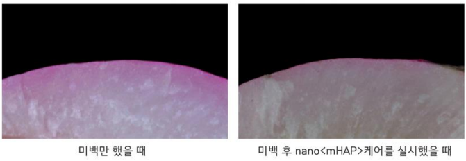 충치예방부터 시린이 완화까지! 아파프로 치아영양제의 5가지 효과✨ / 강남레옹치과 관련 이미지 7
