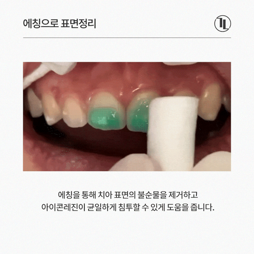 앞니 하얀얼룩 반점치 하루만에 치료, 원인과 사례까지! / 강남레옹치과 관련 이미지 4