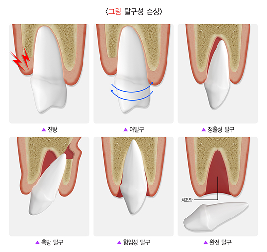 여름 휴가철, 안면외상 주의! 부딪혀서 앞니 흔들림 / 치아가 깨지거나 부러지면 제일 먼저 해야할 대처법은? / 치아 파절과 탈구 비교 관련 이미지 4