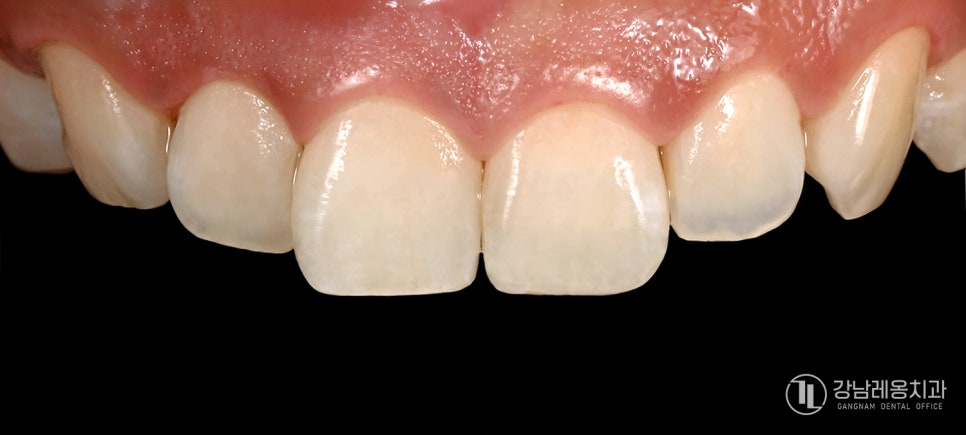 앞니 끝이 살짝 깨졌다면? 뉴티스 치아성형으로 자연스럽게 치아라인 정리하기 관련 이미지 3