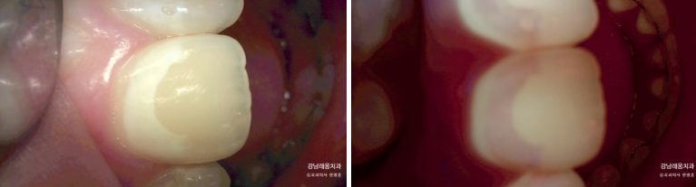 교정 후 치아에 백색반점이? 교정 후 치아탈회 삭제없이 뉴티스 반점치 치료 (아이콘레진) / 강남레옹치과 관련 이미지 4