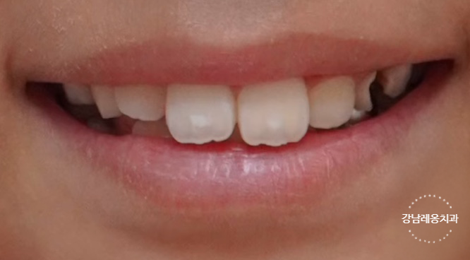 우리 아이 앞니에 하얀 반점! 소아 충치 시작의 신호? / 강남레옹치과 관련 이미지 2