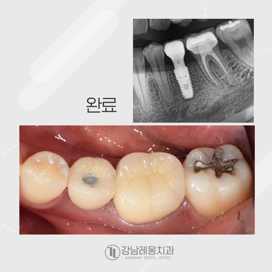 뿌리만 남은 치아, 발치 즉시 임플란트 케이스 관련 이미지 4