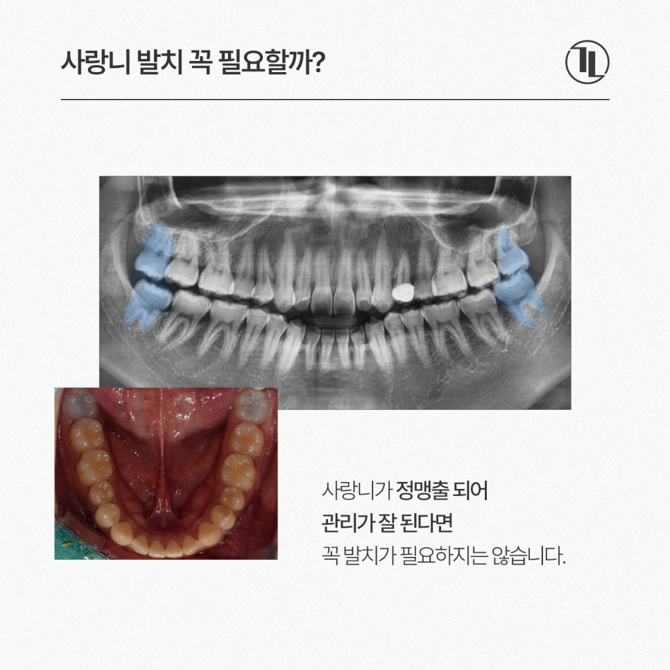 사랑니 발치, 왜 어떤 경우에 대학병원을 권유할까? / 강남레옹치과 관련 이미지 2