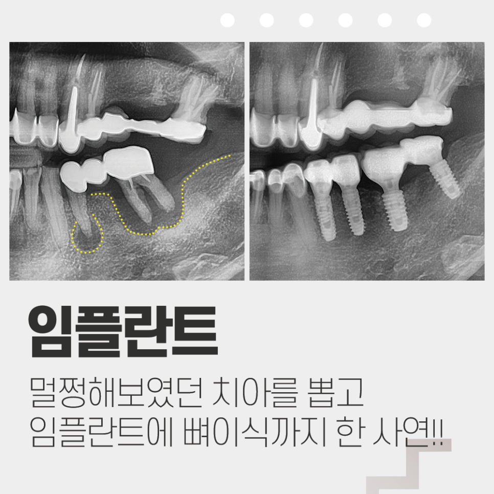 멀쩡한 줄 알았던 오래된 브릿지, 임플란트 수술한 사연 관련 이미지 1