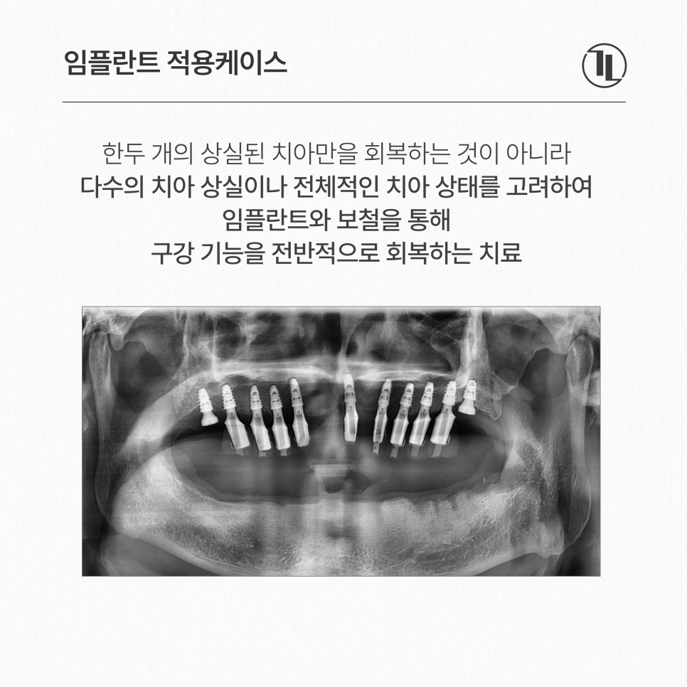 Full-Mouth Implant Treatment Case for Extensive Tooth Loss / Gangnam Leon Dental Clinic image 2
