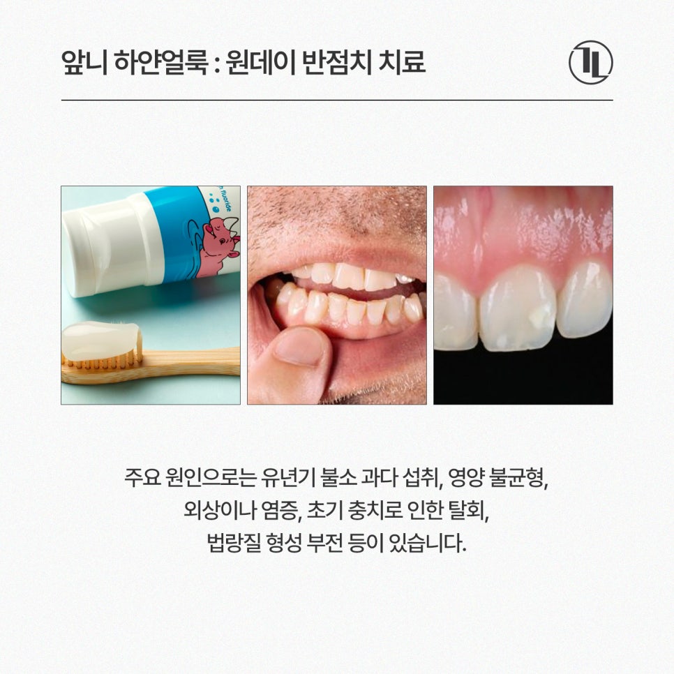 앞니 하얀얼룩, 하루만에 제거! 뉴티스 반점치 치료 / 강남레옹치과 관련 이미지 2