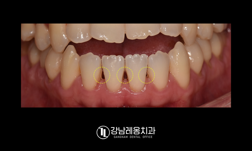 잇몸과 치아 사이 공간 &lsquo;블랙트라이앵글&rsquo;을 무시하면 안되는 이유! / 생기는 원인과 해결 방법 / 강남레옹치과 관련 이미지 4