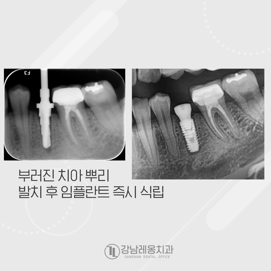 뿌리만 남은 치아, 발치 즉시 임플란트 케이스 관련 이미지 3