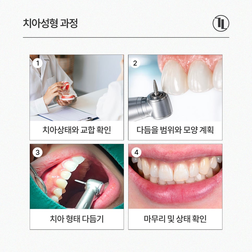 살짝 깨진 앞니 끝, 치아성형으로 고르게 다듬기 / 강남레옹치과 관련 이미지 4