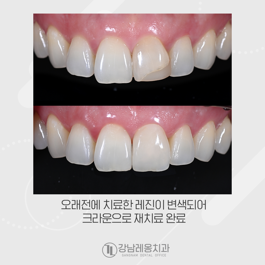 오래된 레진 변색, 강남레옹치과에서 앞니 크라운 치료 관련 이미지 4