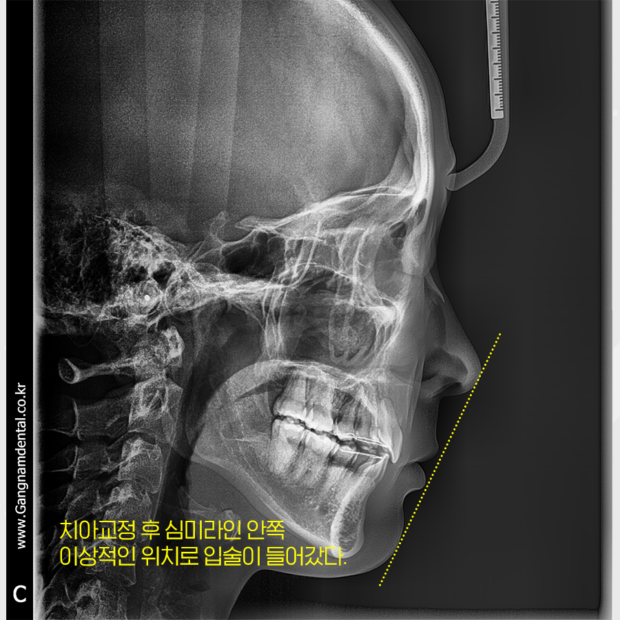 뻐드러진 앞니 각도를 조절하여 돌출입 교정 관련 이미지 3