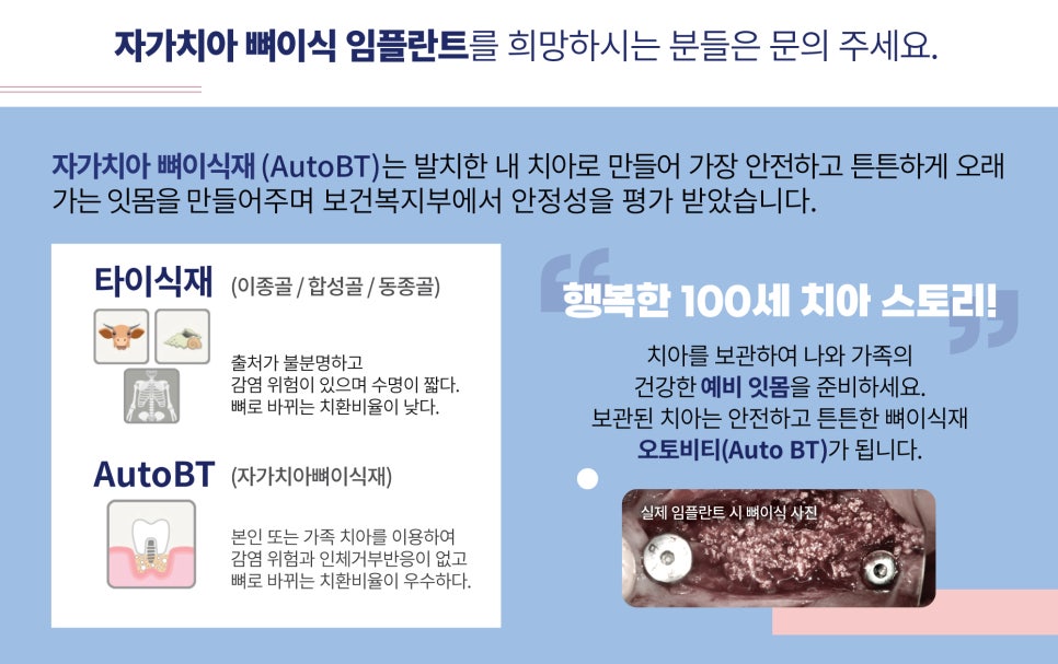 자가치아골이식술, 임플란트 할 때 내 이로 만든 뼈 사용!! 관련 이미지 2