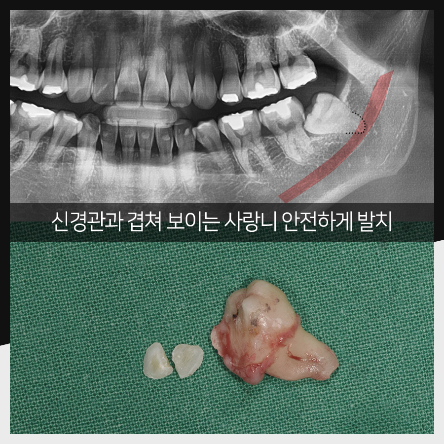 강남레옹치과 사랑니 발치, 결과가 증명해주는 실력! 관련 이미지 20