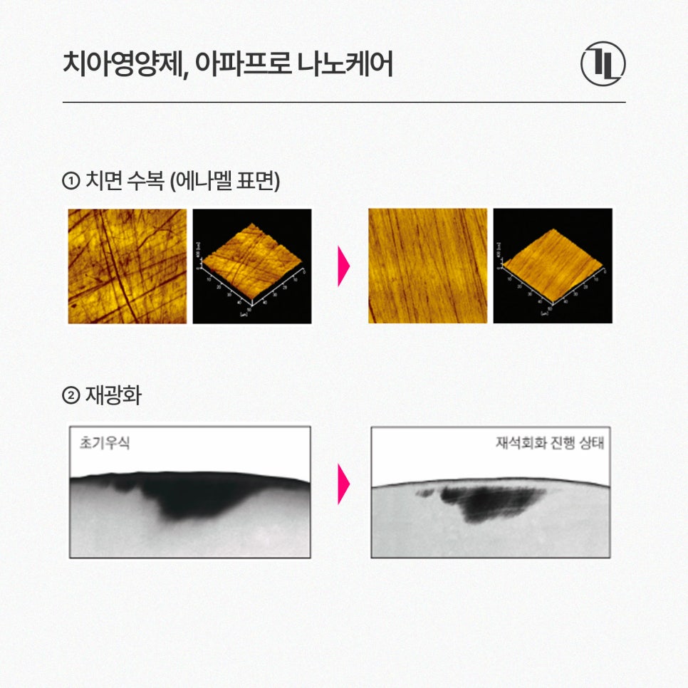 환절기 치아 시림, 아파프로 나노케어로 민감성 치아 관리하기 / 강남레옹치과 관련 이미지 4