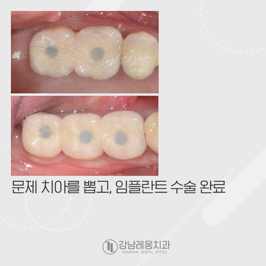 어금니 충치 미루면 임플란트 수술 할 때 뼈이식도 관련 이미지 4