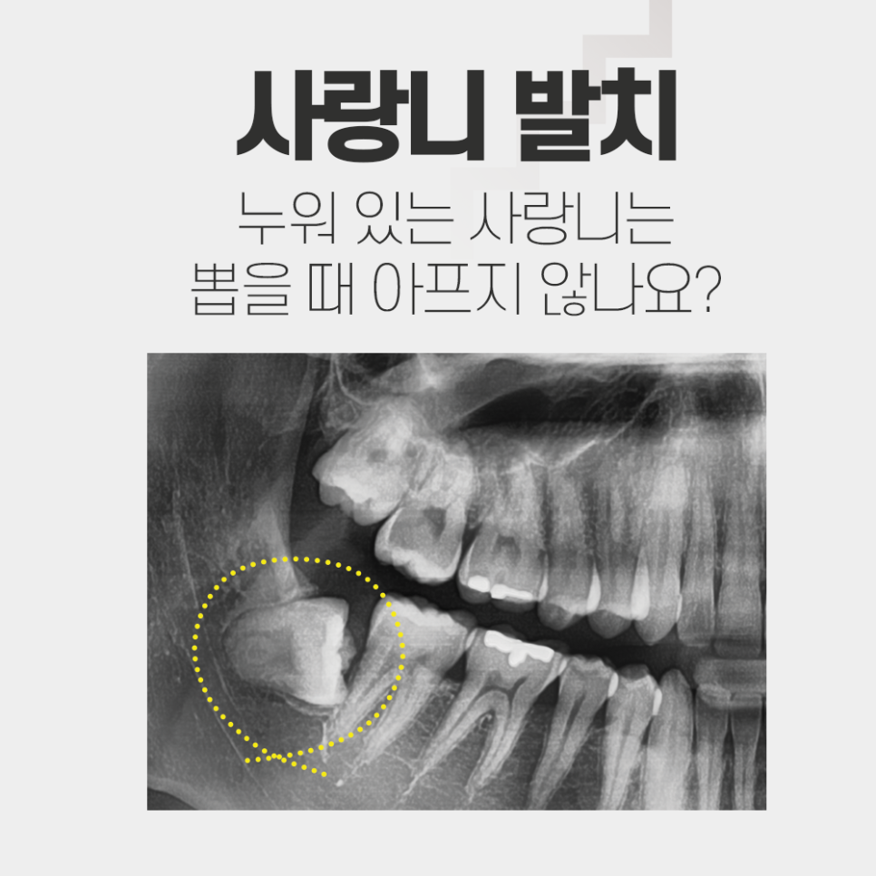 강남레옹치과 위아래 2개 사랑니발치 시간, 가격? 당일 가능? 관련 이미지 1