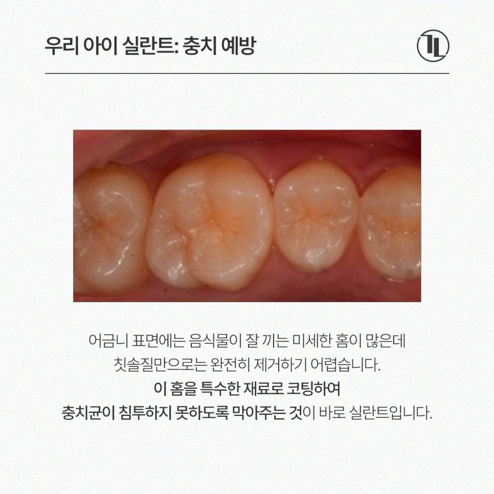 어린이 실란트, 언제 해야 할까? 시기와 보험 혜택까지 쉽게 설명 / 강남레옹치과 관련 이미지 2