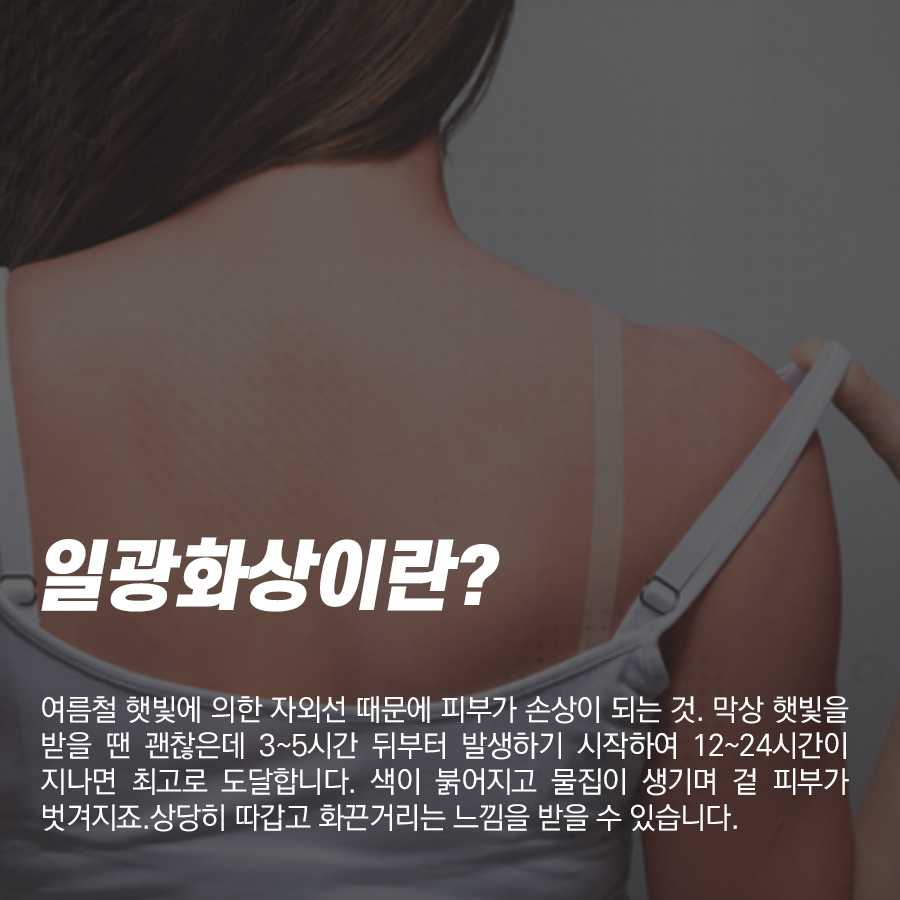 방심하기 쉬운 일광화상 물집 응급처치, 자외선 강한 요즘 꼭 주의! 관련 이미지 2