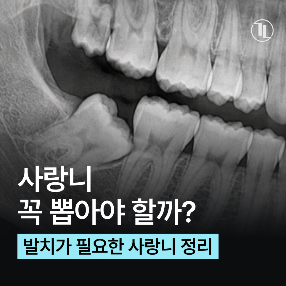 사랑니 안 아픈데 꼭 뽑아야 될까요?발치가 필요한 경우 / 강남레옹치과 관련 이미지 1