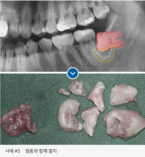 사랑니 발치, 왜 어떤 경우에 대학병원을 권유할까? / 강남레옹치과 관련 이미지 13