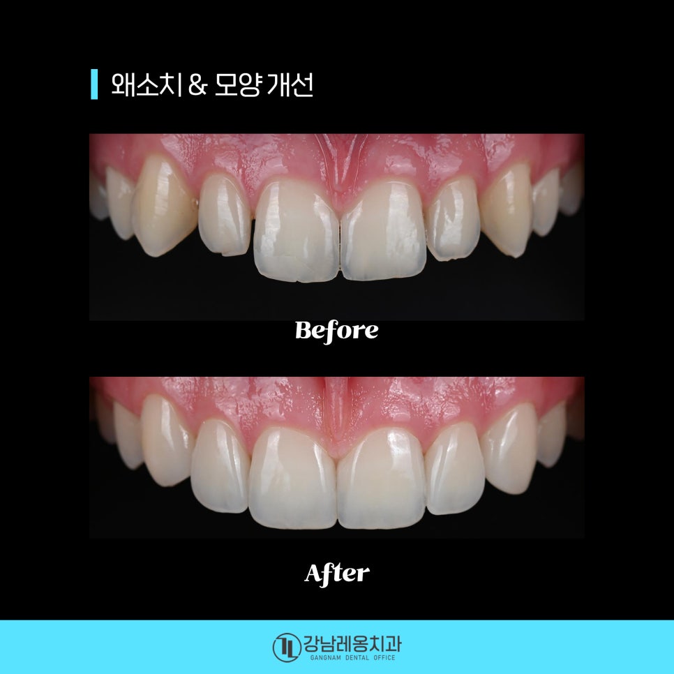 최소삭제 라미네이트 &lsquo;뉴티스&rsquo;의 시술 후 관리방법은? / 양치질, 치실 사용방법 / 강남레옹치과 관련 이미지 7