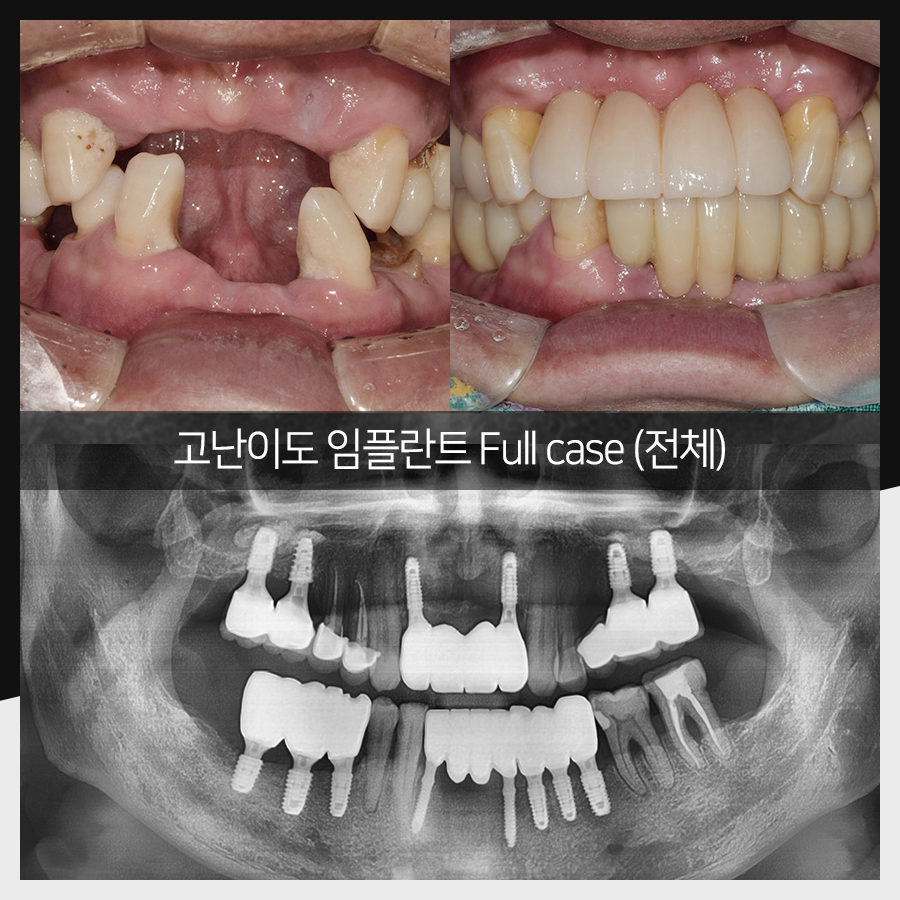 강남레옹치과 임플란트 수술 증례 한눈에 보기, 명불허전! 관련 이미지 6