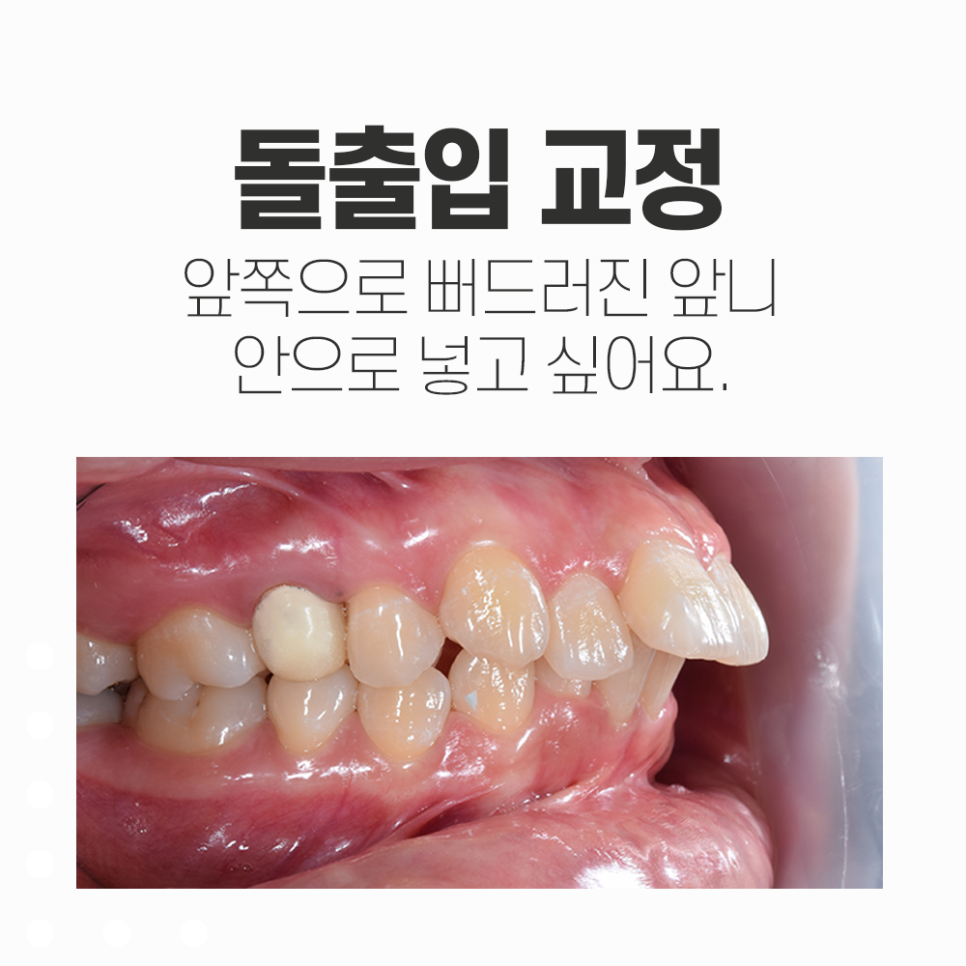 강남레옹치과 치아 교정, 돌출입 두가지 케이스 관련 이미지 1
