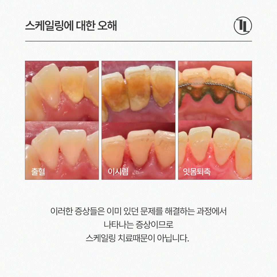 치아 스케일링 후 이시림 / 식사는? / 강남레옹치과 관련 이미지 5