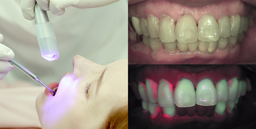 뉴티스 반점치 치료✨ 최다 임상적용, 반점치 제거 아이콘레진 / 강남레옹치과 관련 이미지 4