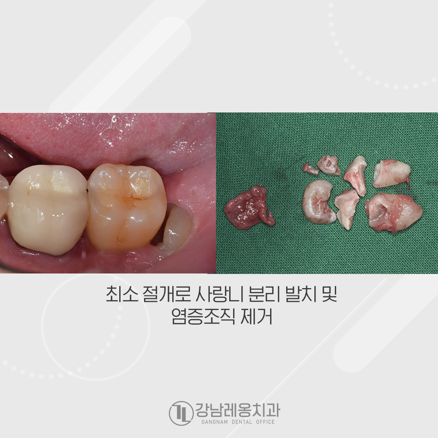 누운 사랑니 발치, 신경관과 겹쳐있는데 강남레옹치과에서 가능한가요? 관련 이미지 4