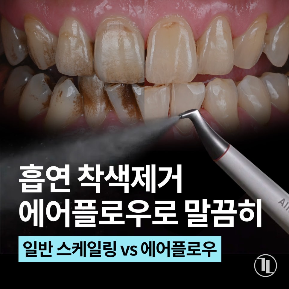 흡연, 담배 치아착색 에어플로우로 말끔하게🌊 / 스케일링 강남레옹치과 관련 이미지 1