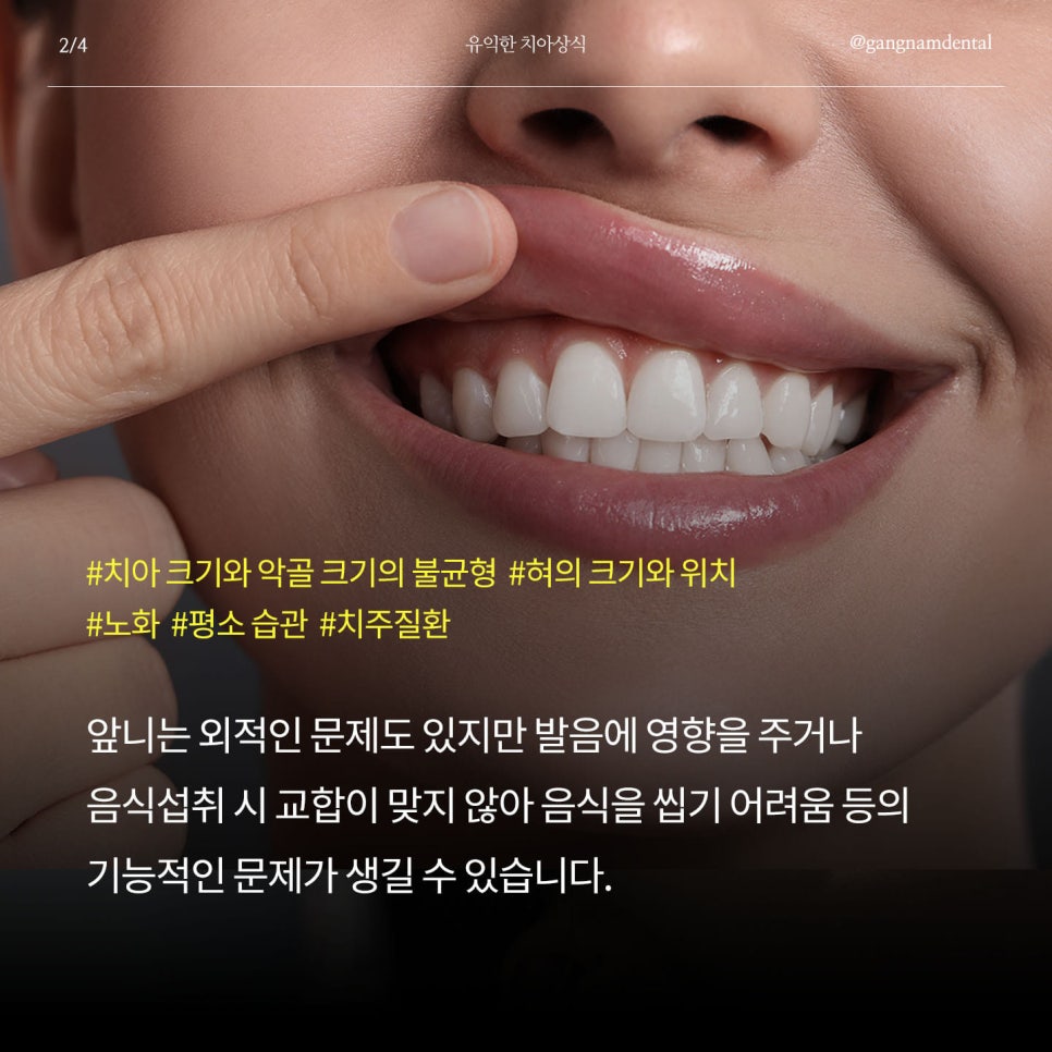 치아 벌어짐 / 앞니 사이 간격 넓어짐 / 정중이개 원인의 증상 그리고 개선할 수 있는 방법에 대해 관련 이미지 3
