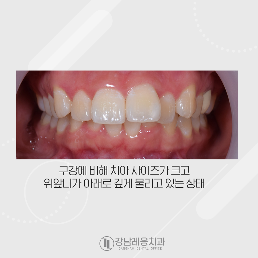 강남레옹치과 치아 교정, 돌출입 두가지 케이스 관련 이미지 2