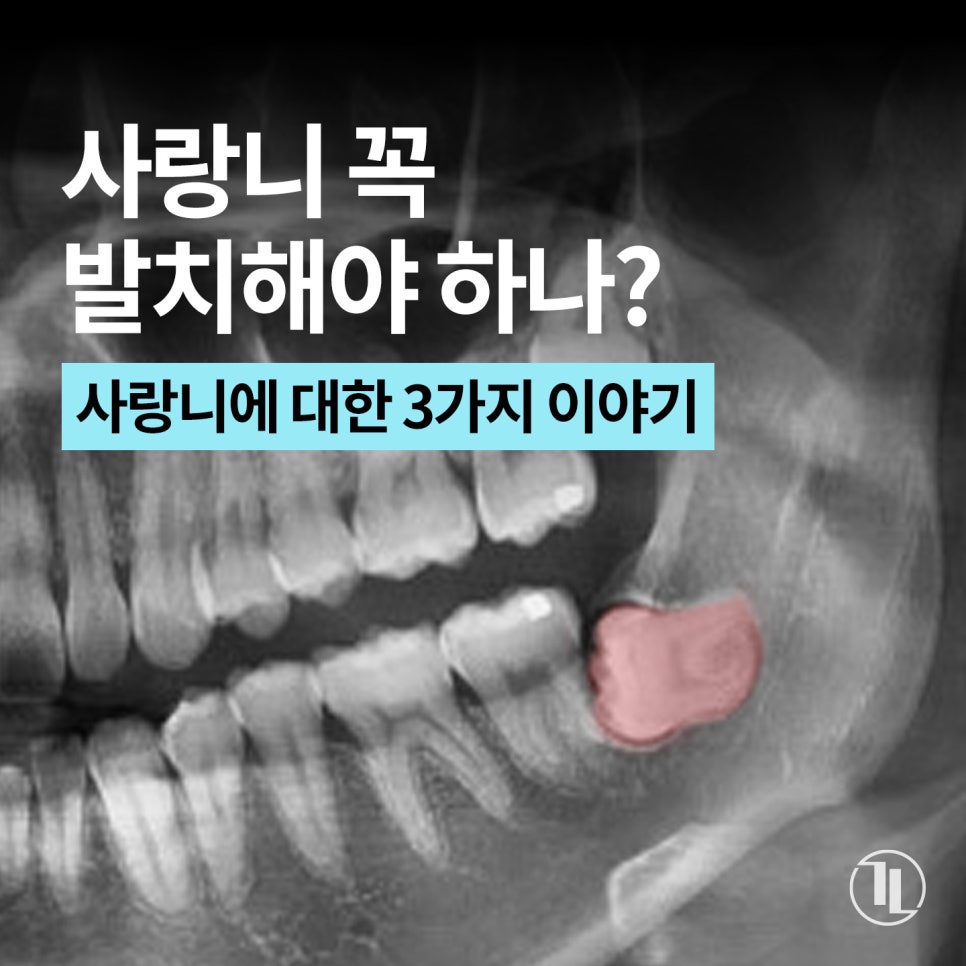 사랑니, 통증 없다고 그냥 둬도 될까? 사랑니의 3가지 사실 / 강남레옹치과 관련 이미지 1