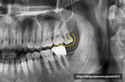 아래 사랑니만 발치해도 괜찮을까? 강남역 사랑니발치 /  강남레옹치과 관련 이미지 2